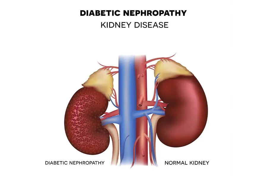 What is Nephropathy?