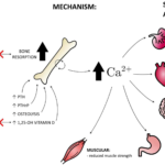 What is Hypercalcemia?