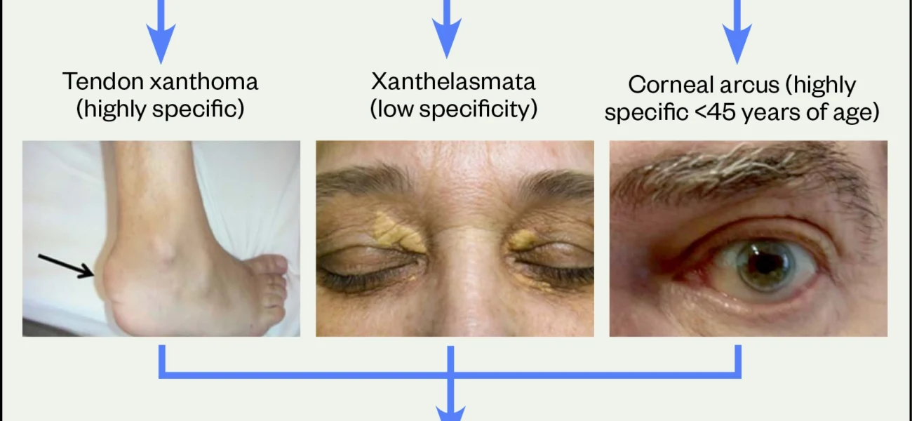 What is Hypercholesterolaemia?