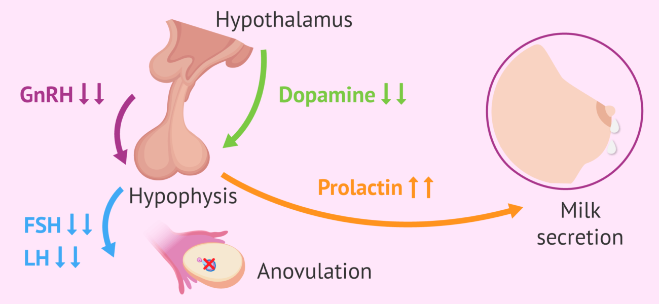What is Hyperprolactinemia?