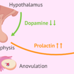 What is Hyperprolactinemia?