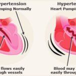 What is Hypertension?