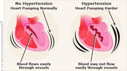 What is Hypertension?