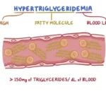 what is Hypertriglyceridemia