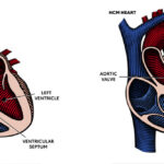 what is Hypertrophic cardiomyopathy