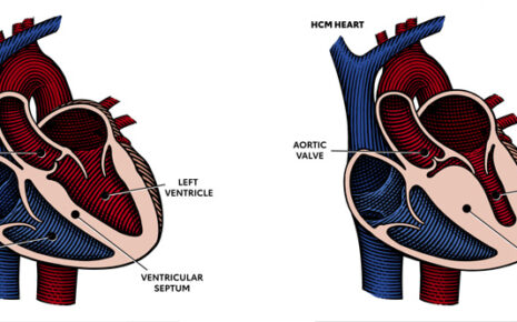 what is Hypertrophic cardiomyopathy