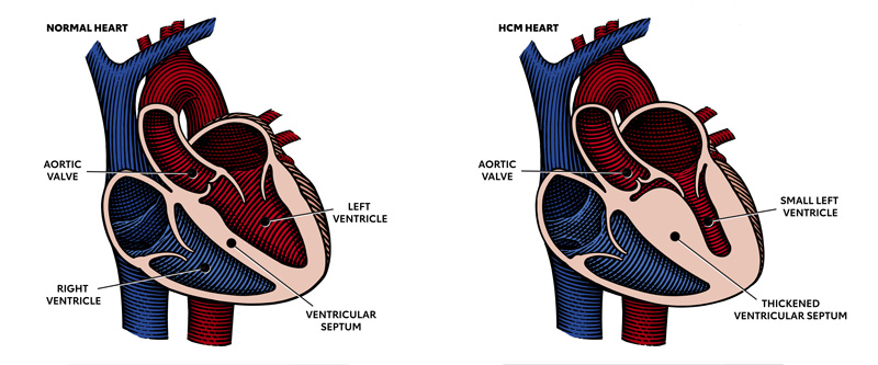 what is Hypertrophic cardiomyopathy
