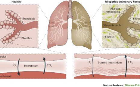 Idiopathic Pulmonary Fibrosis