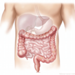 what is Intestinal Disorder