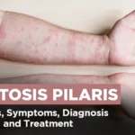 What is Keratosis Pilaris