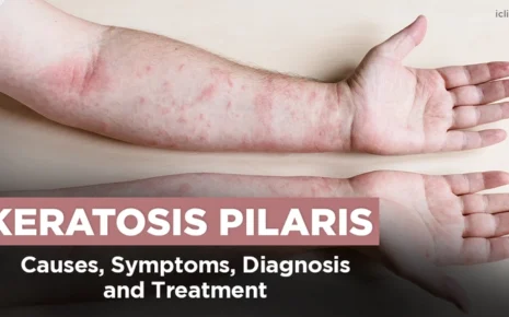 What is Keratosis Pilaris