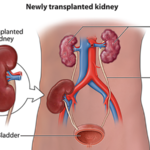 What is Kidney Transplant