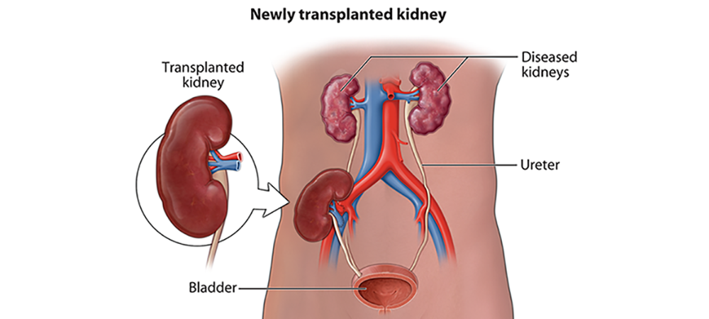 What is Kidney Transplant