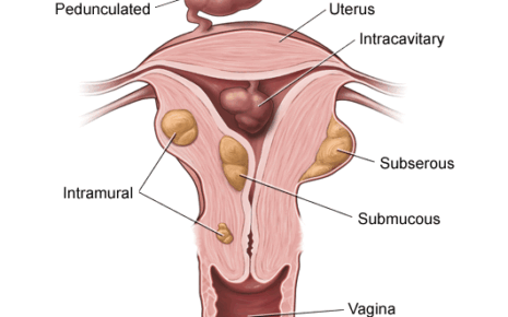 What is Leiomyosarcoma