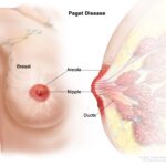What is Lesions in Paget’s Disease: