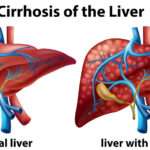 What is Liver Cirrhosis