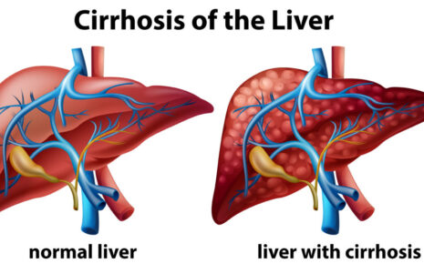 What is Liver Cirrhosis