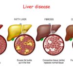 What is Liver Fibrosis: