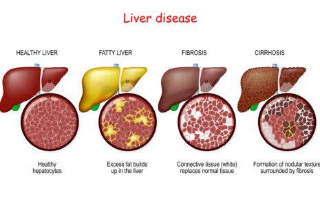 What is Liver Fibrosis: