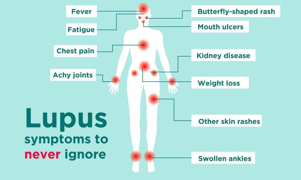 What is Lupus: