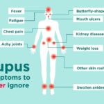 What is Lupus: