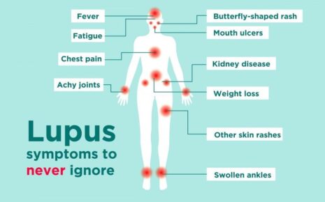What is Lupus: